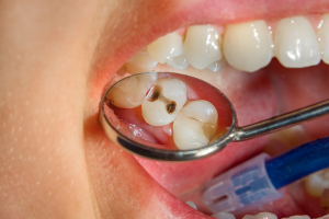 Photo of caries in human teeth.