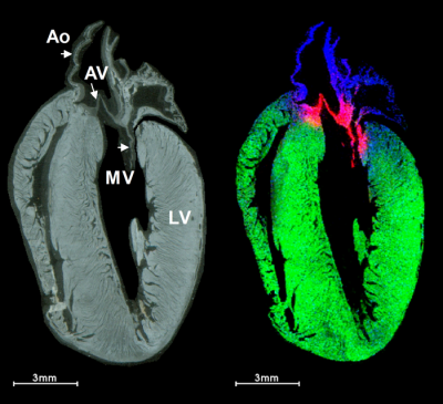 Rat heart N-glycans detected by imaging mass spectrometry. Left: fixed tissue section from rat heart. Ao: aorta; AV: aortic valve; MV: mitral valve; LV: left ventricle. Right: three N-glycans with unique spatial location aligning to aorta (blue), aortic valve (pink) or the ventricles (green). Credit: This image was provided by Dr Peggi Angle of the Medical University of South Carolina. Mass spectrometry image of rat heart