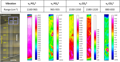 Chemical distribution of carbonates and phosphates in the middle crown of a bovine incisor control tooth (vertical section). Chemical distribution of carbonates and phosphates in a tooth by band vibration.